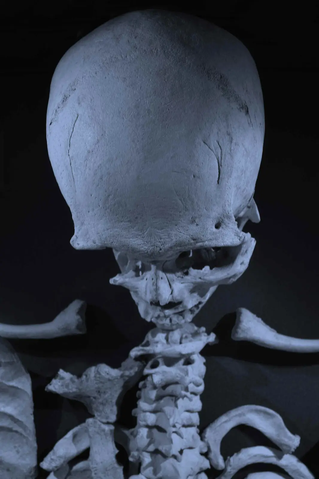 A close-up of a human skeleton's head and upper torso against a dark background, with the skull appearing unusually flat and…