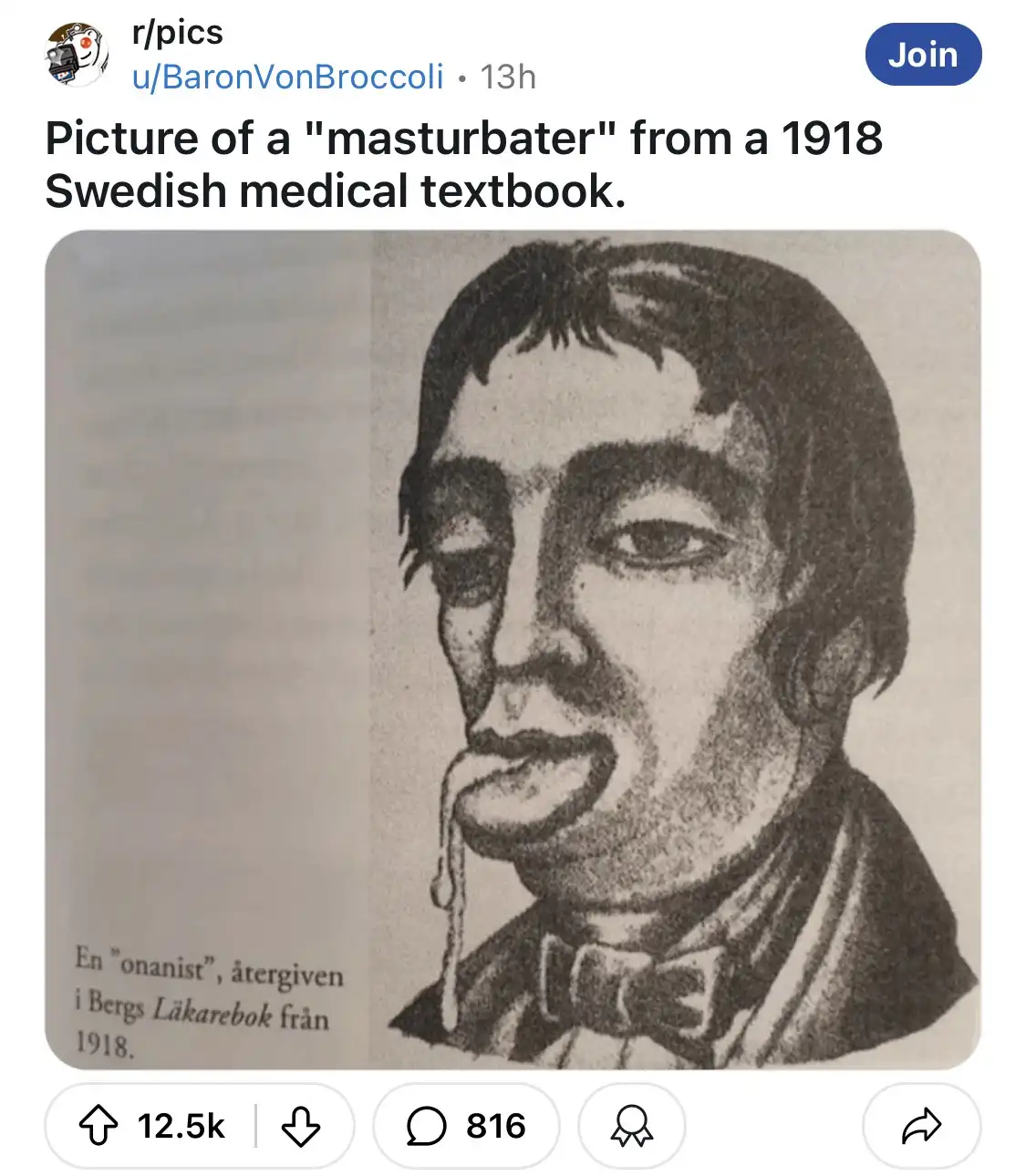 A grainy, black-and-white illustration from a 1918 Swedish medical textbook depicts a man in a bow tie with his tongue…