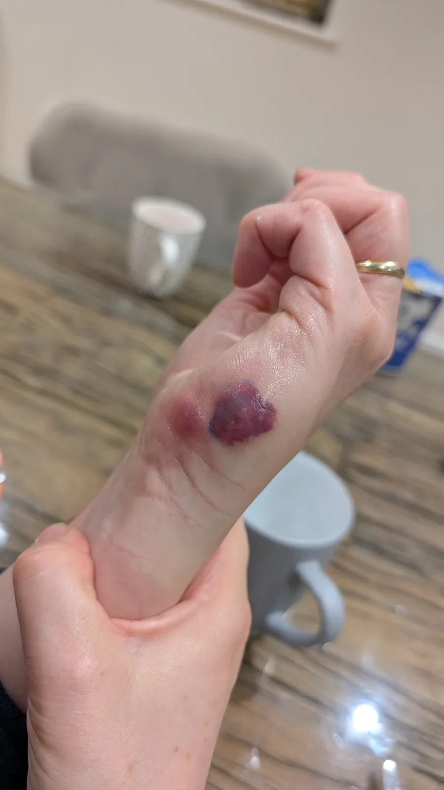 Bizarre Bruises: What’s Going On?