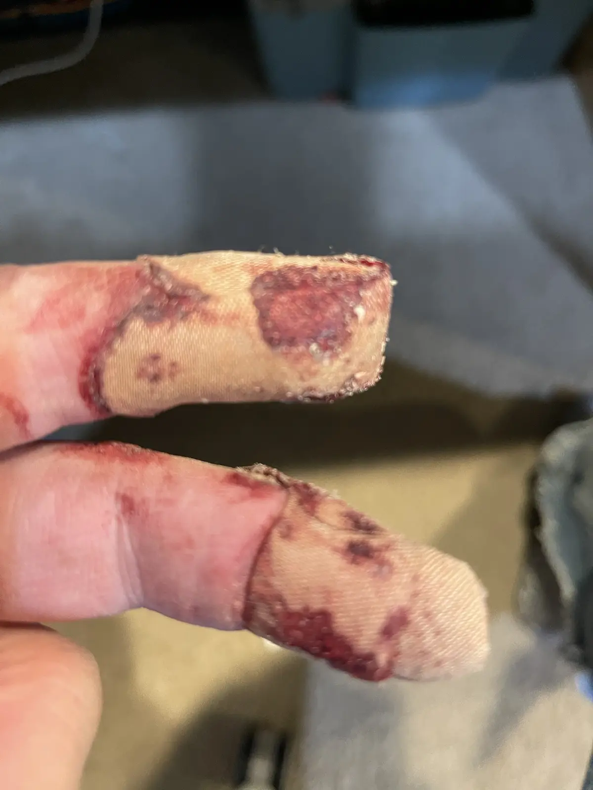 A close-up photo shows two fingers with severe cuts and blood, wrapped in dirty, stained gauze bandages. The overlaid text…