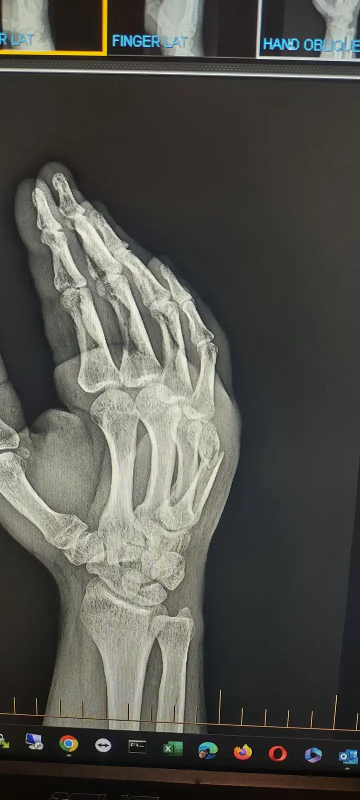 An x-ray image of a human hand displayed on a computer monitor, showing the bones in a praying position with fingers…
