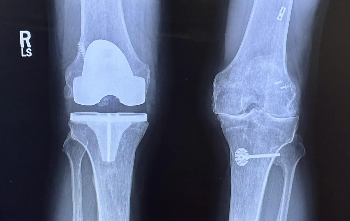 An x-ray image displays two knees side-by-side; the left knee has a full knee replacement with visible prosthetic…
