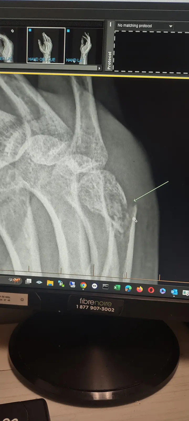 Latest Update on the Hand Situation