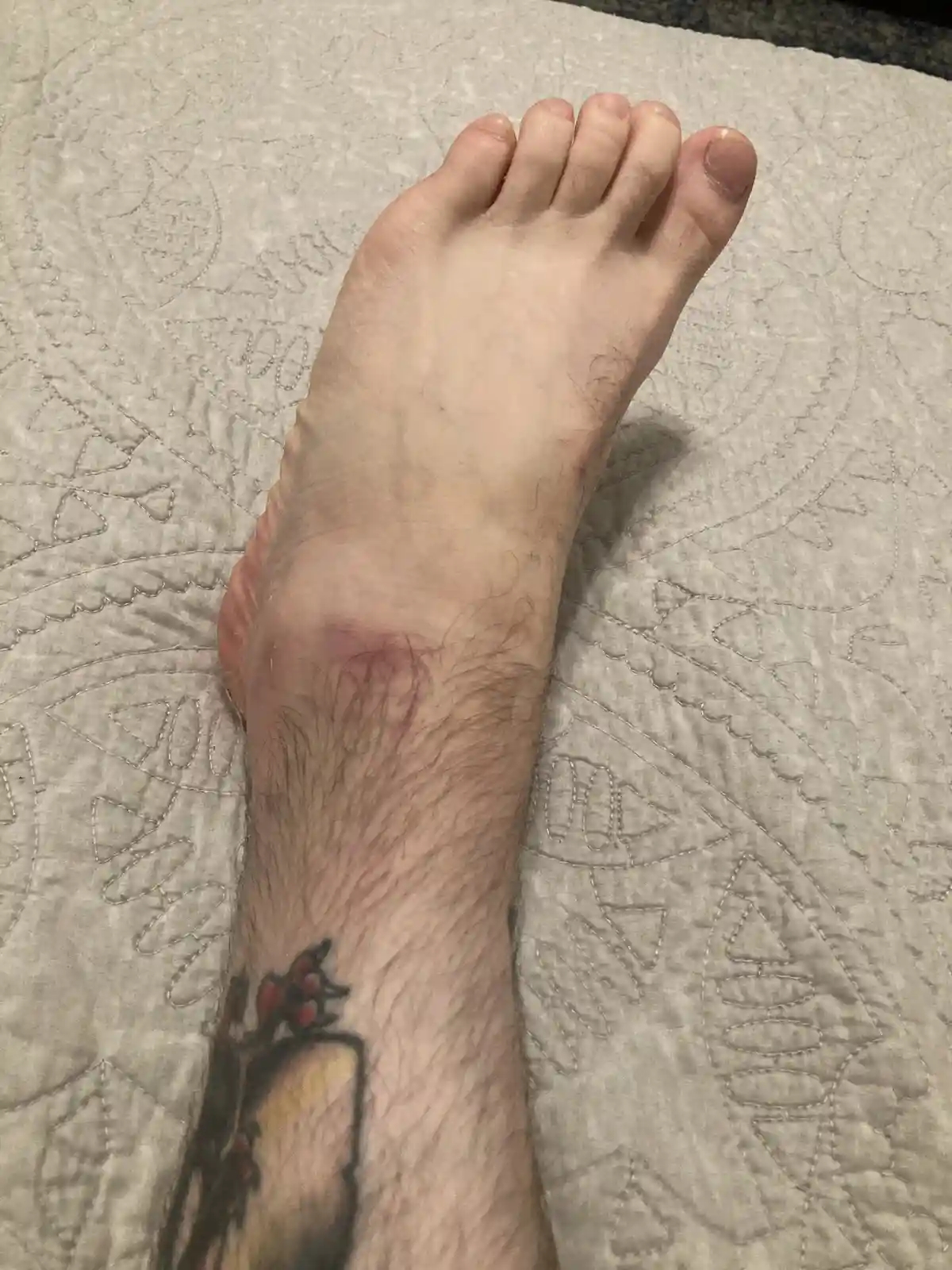 A close-up photo shows a person's bare foot and ankle resting on a light-colored quilted bedspread. The ankle has a visible…