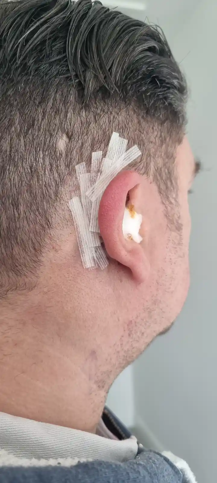 A close-up profile shot of a person's right ear and side of head, showing a white cotton ball packed into the ear canal and…