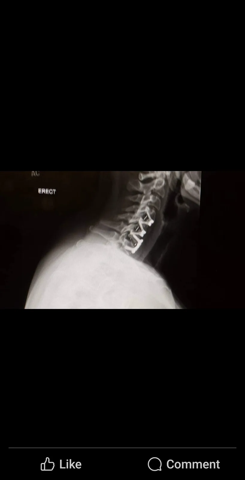 An x-ray image shows a person's cervical spine with visible surgical hardware, including rods and screws fused to the…